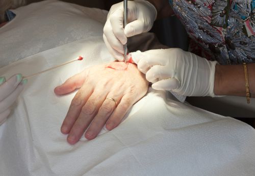 Doctor making an excision during a Mohs surgery procedure